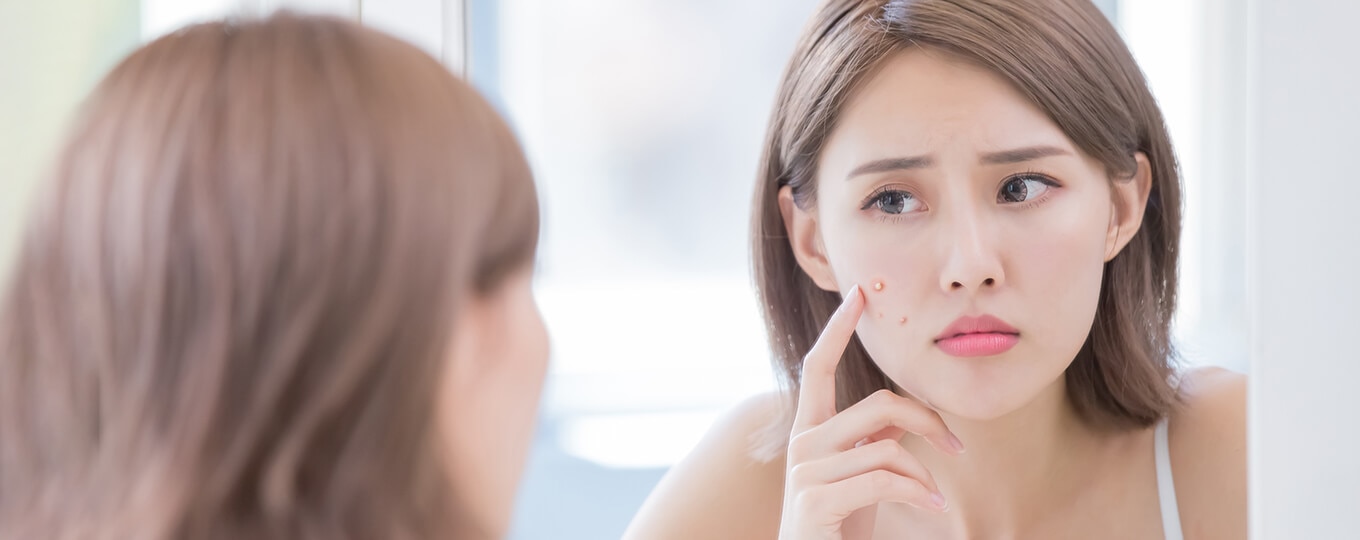 สิววนลูปขึ้นบนหน้า