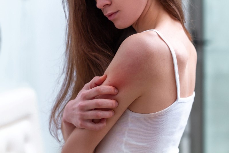 Lady dressed in white vest showing back full of skin rashes.